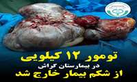 تومور ۱۲ کیلویی از شکم بیمار در بیمارستان گراش خارج شد
